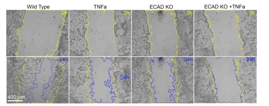 Combined effect of E-cadherin loss-of-function and pro-inflammatory activation supports a 2-hit model for E-cadherin loss in the neural crest